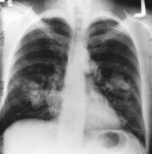 gejala kanker paru-paru