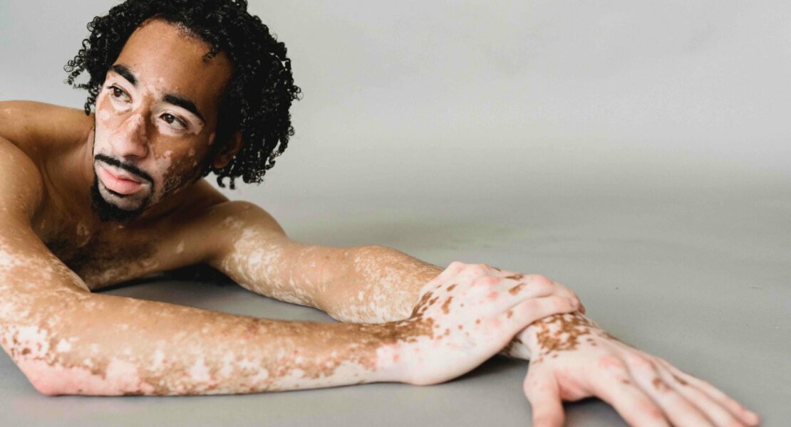 Viral, Dokter Kena Vitiligo, Penyakit Apakah Itu?