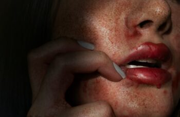 Kenali Gejala Sifilis & Cara Ampuh Cegah Penularan | WeCareid