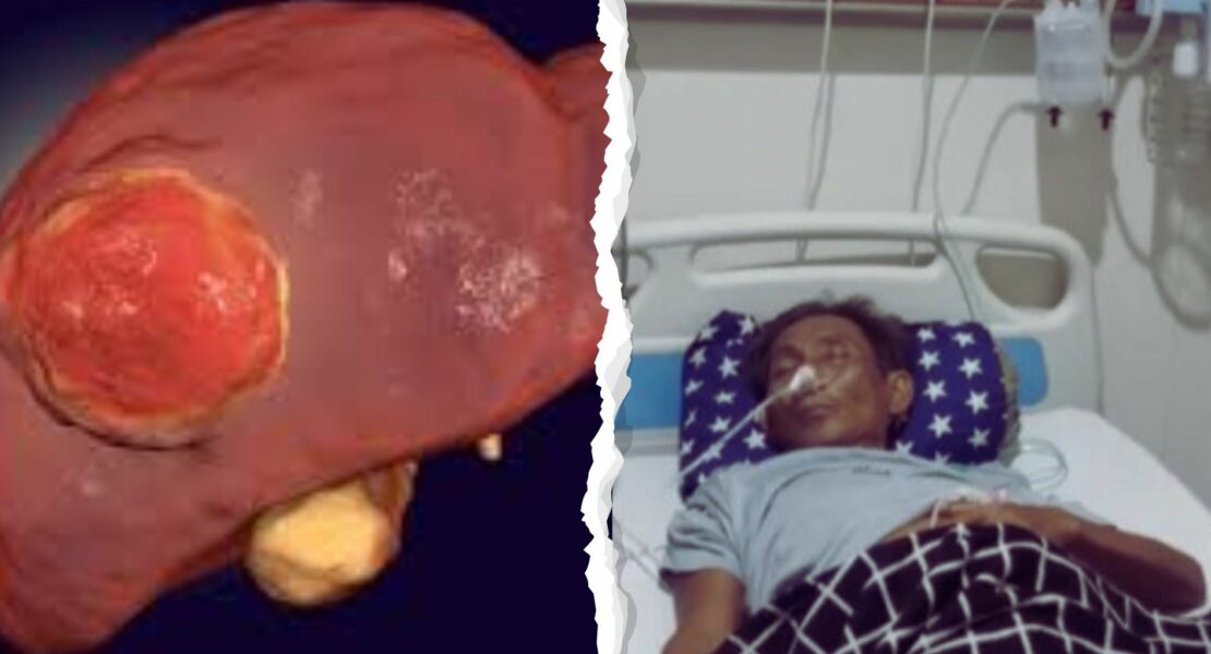 Apakah Kanker Hati Bisa Sembuh? Ini Fakta Medisnya