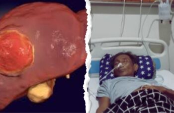 Apakah Kanker Hati Bisa Sembuh? Ini Fakta Medisnya | WeCare.id